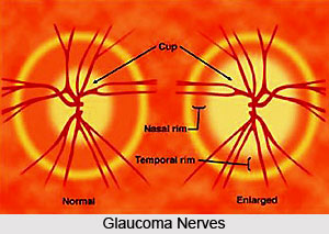 Types of Glaucoma