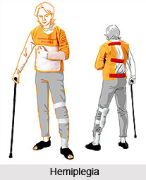 Paralytic Afflictions or Pakshaghat