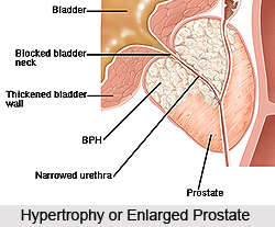 Types of Prostate Disorders