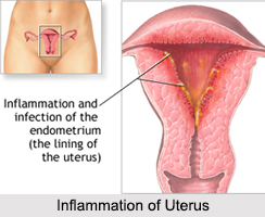 Inflammation of Uterus, Female Disease