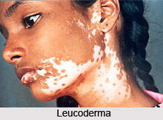 Leucoderma