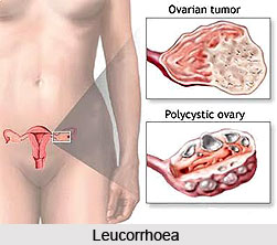 Leucorrhoea