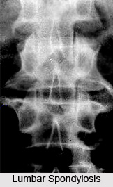 Causes of Lumbar Spondylosis