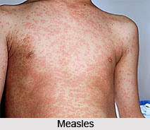 Measles