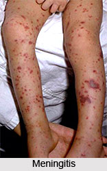Types of Meningitis