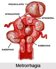 Menorrhagia and Metrorrhagia i.e. Rakta Pradara