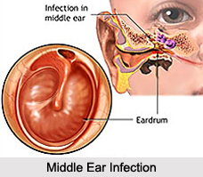 Middle Ear Infection, Naturopathy