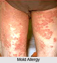 Contact allergy