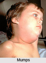 Mumps