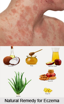 Natural Remedy for Eczema, Indian Naturopathy