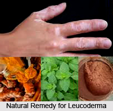 Natural Remedy for Leucoderma, Indian Naturopathy
