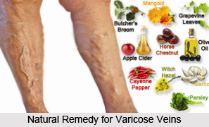 Natural Remedy for Varicose Veins, Indian Naturopathy