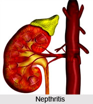Nepthritis