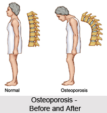 Osteoporosis