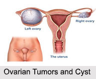 Ovarian Tumors and Cysts, Female Disease