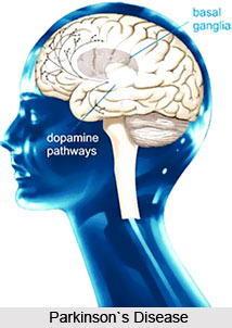 Symptoms of Parkinson`s Disease