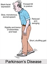 Parkinson