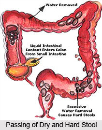 Constipation