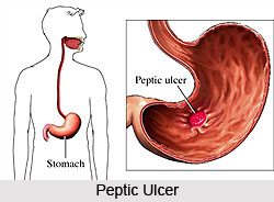 Peptic Ulcer