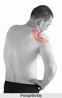 Periarthritis, Type of Arthritis