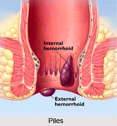 Treatment of Piles