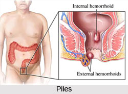 Causes of Piles