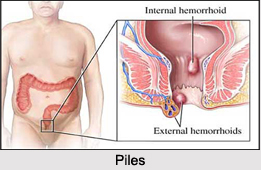 Piles, Naturopathy