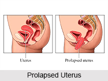 Natural Remedy for the Prolapse of Uterus, Naturopathy