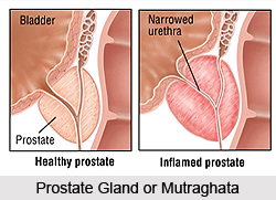 Enlargement of the Prostate Gland or Mutraghata