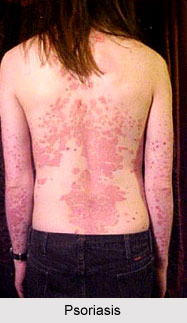 Psoriasis