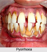 Pyorrhoea