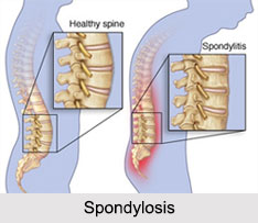 Spondylosis, Joint and Muscle Ailment