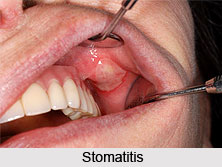 Stomatitis