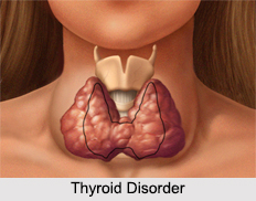 Thyroid Disorder, Female Disease