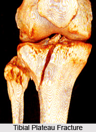 Causes of Arthritis