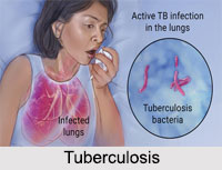 Tuberculosis, Chest Ailment