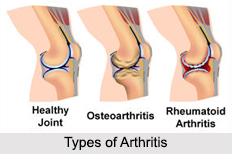 Types of Arthritis, Bone Ailment