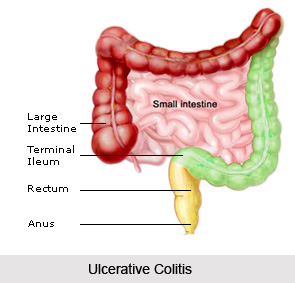 Treatment of Colitis