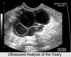 Symptoms of Ovarian Tumors And Cysts