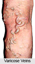 Varicose Veins