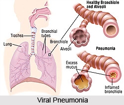 Types of Pneumonia