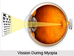 Myopia or Dristi Dosha