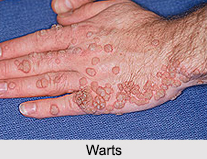Warts, Skin Disorder