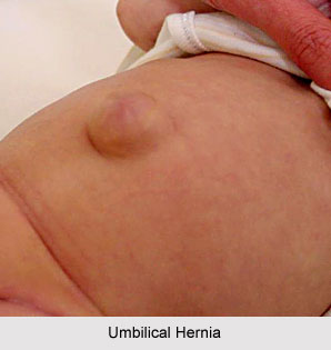 Yoga For Hernia