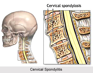 Yoga For Spondylitis
