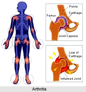 Yoga For Arthritis