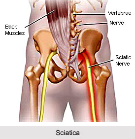 Yoga For Sciatica