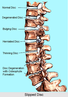Yoga For Slipped Disc