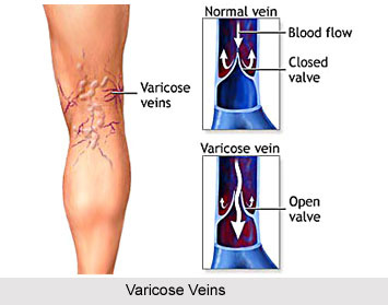 Yoga For Varicose Veins