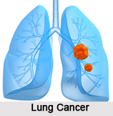 Cancer, Naturopathy